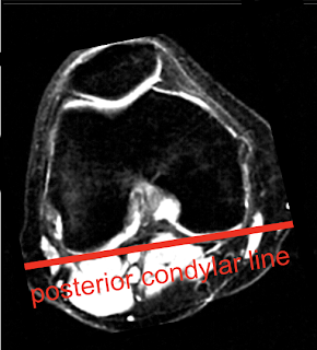 Knee_Coronal