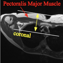 Pec_Coronal