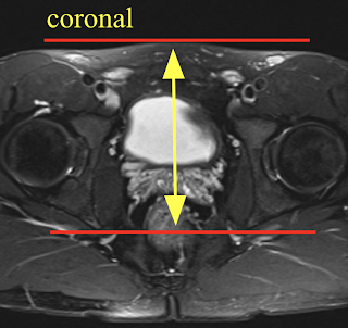 SH_coronal