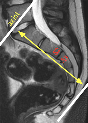 Sacrum_Axial