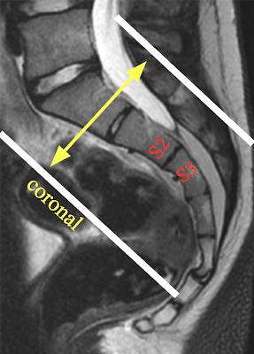 Sacrum_Coronal