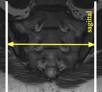 Sacrum_Sagittal