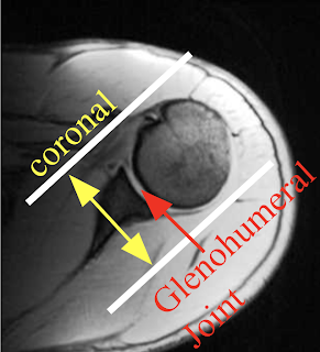 Shoulder_coronal