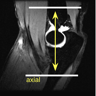 elbow_axial