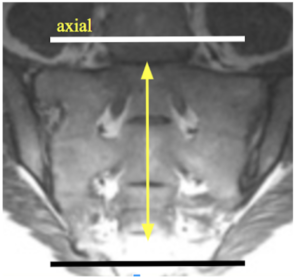 sacrum